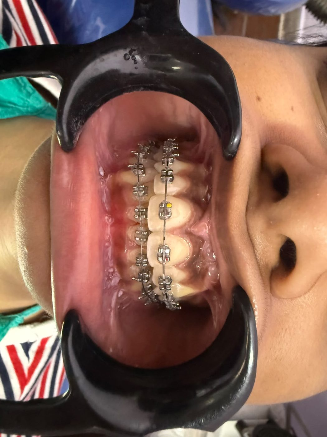 Close-up of orthodontic braces on a patient’s teeth during treatment at Happy Tooth, Pune